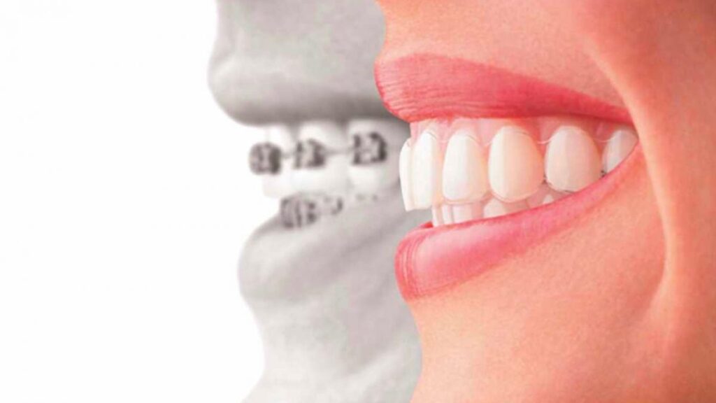 invisalign x aparelho fixo