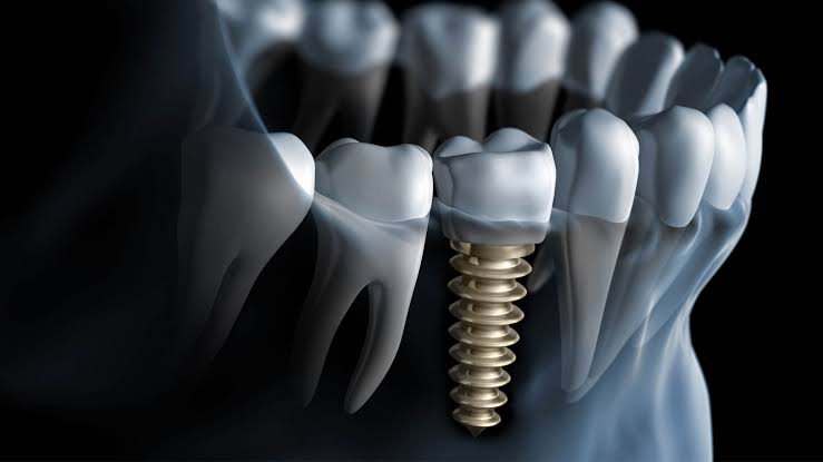 implante dentário em porto alegre