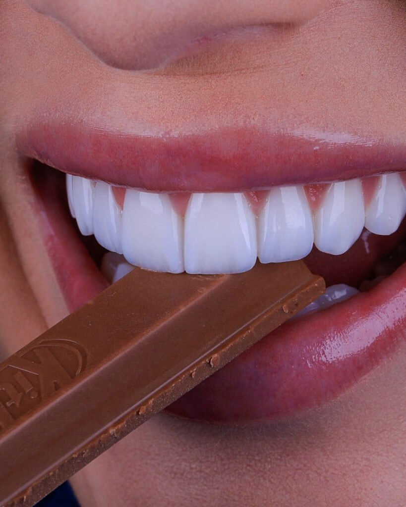 lente de contato dental em poa