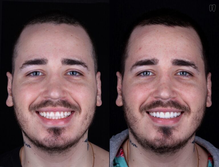 lente de porcelana antes e depois