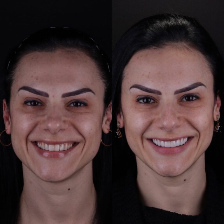 antes e depois de lente de porcelana em porto alegre