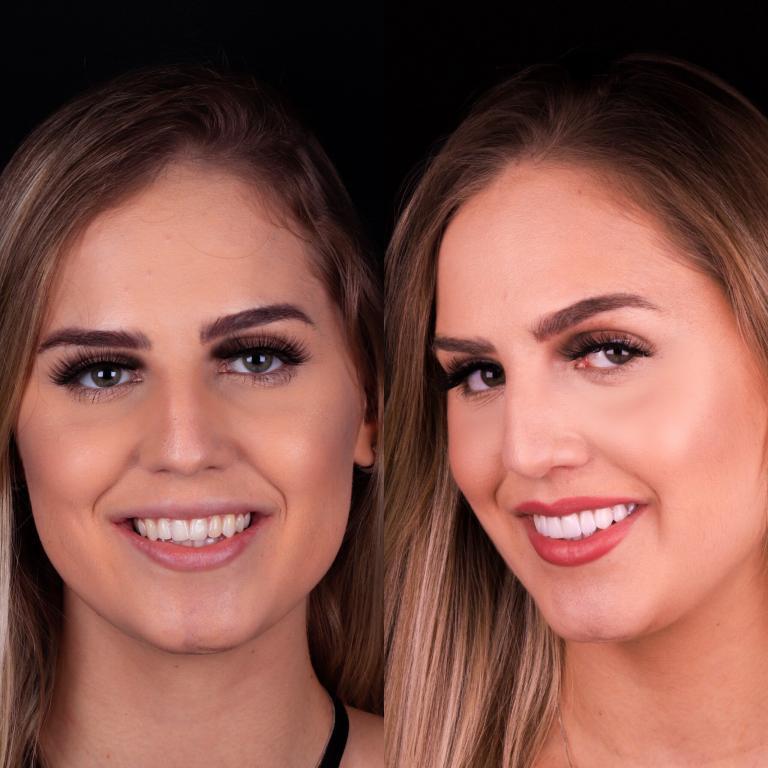 antes e depois lentes de contato dentais da sophia