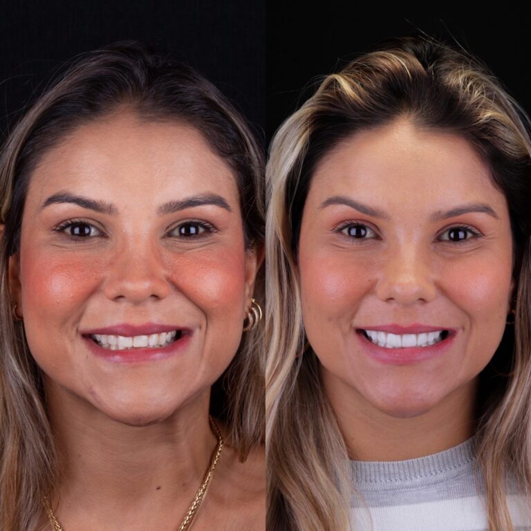 antes e depois lente de contato dental em porto alegre