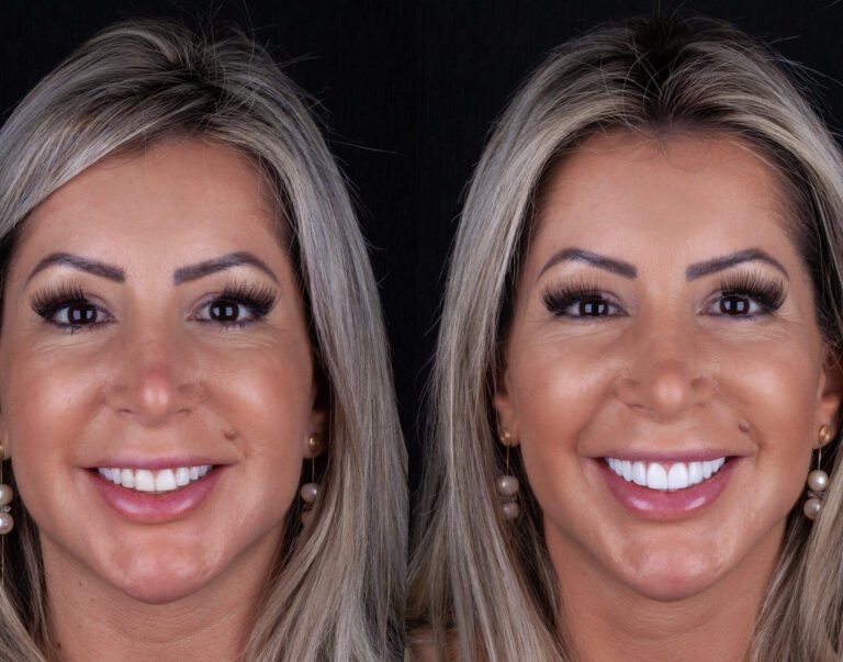 antes e depois das lentes de contato dentais de porcelana andressa