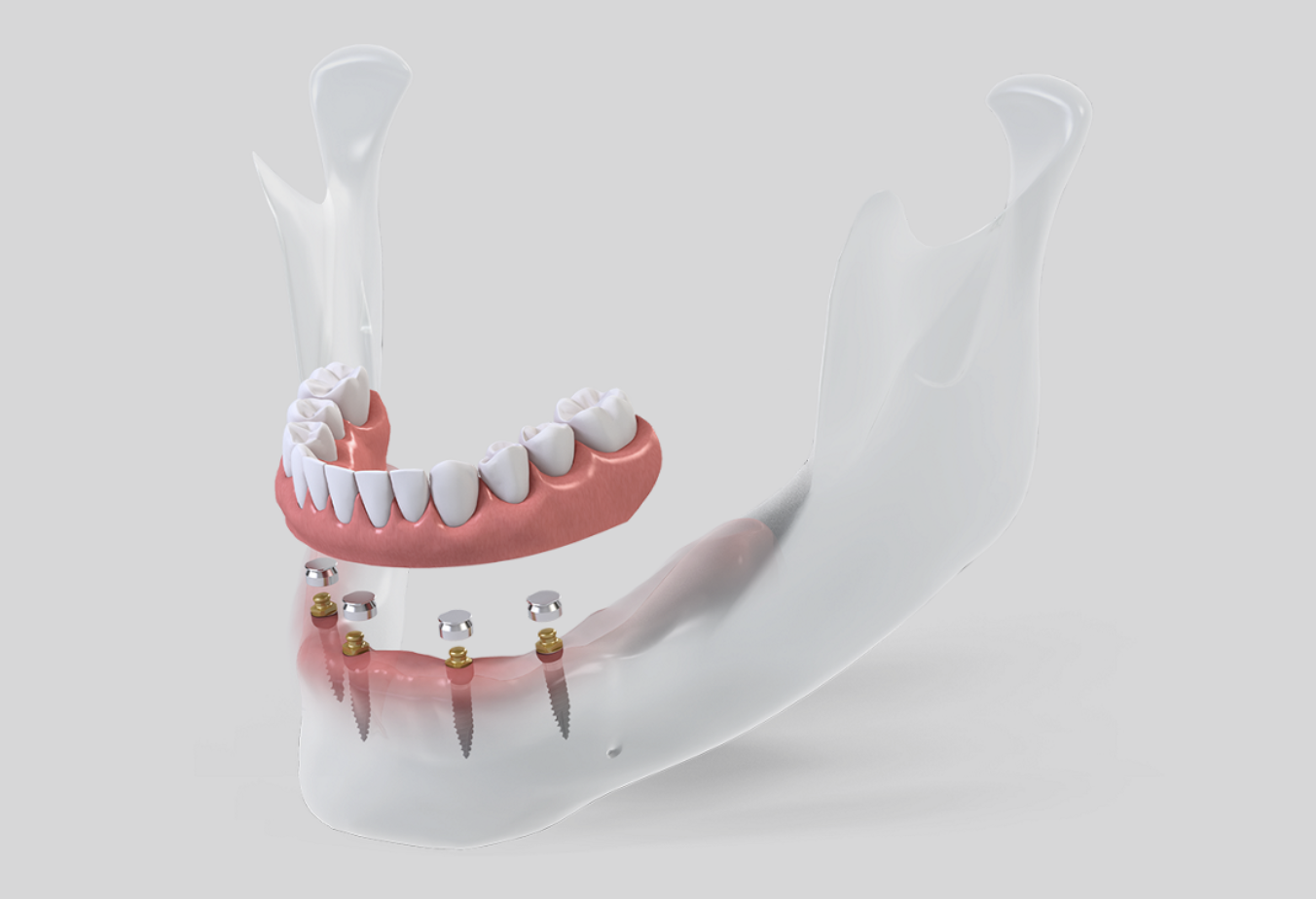reabilitação oral com implantes em Porto Alegre